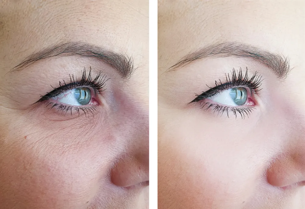 Under-Eye Treatment